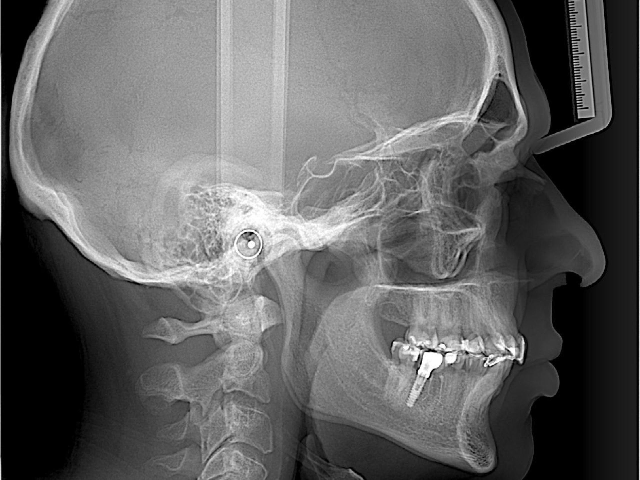 Telerradiografía Lateral